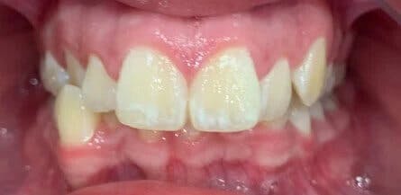 Dental Braces Before