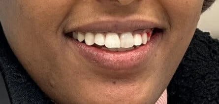 Dental Braces After