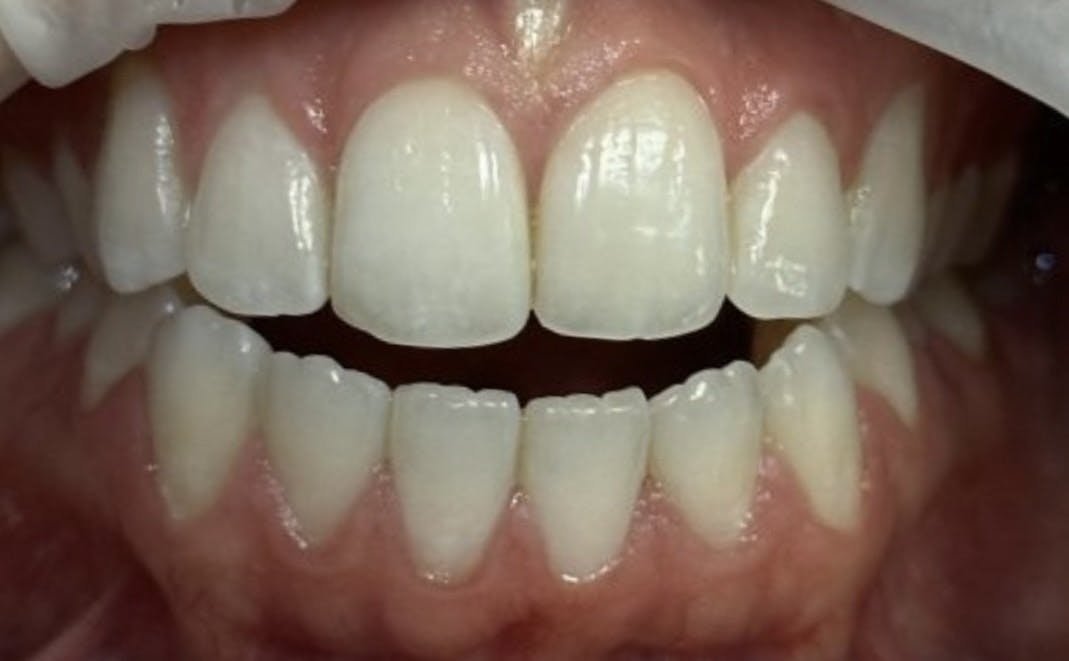 Invisalign Before