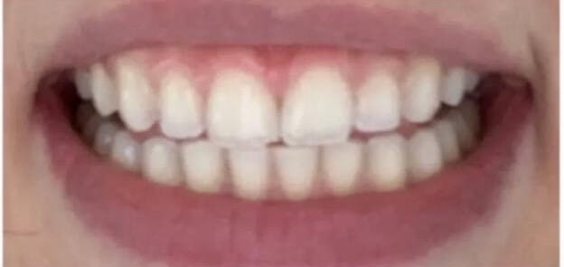 Teeth Whitening After